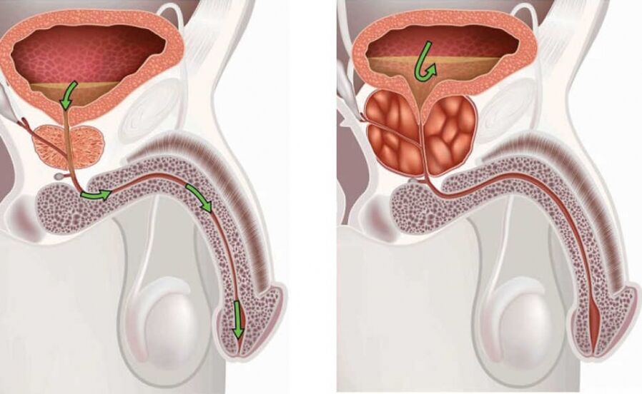 Informace o onemocnění prostatitida